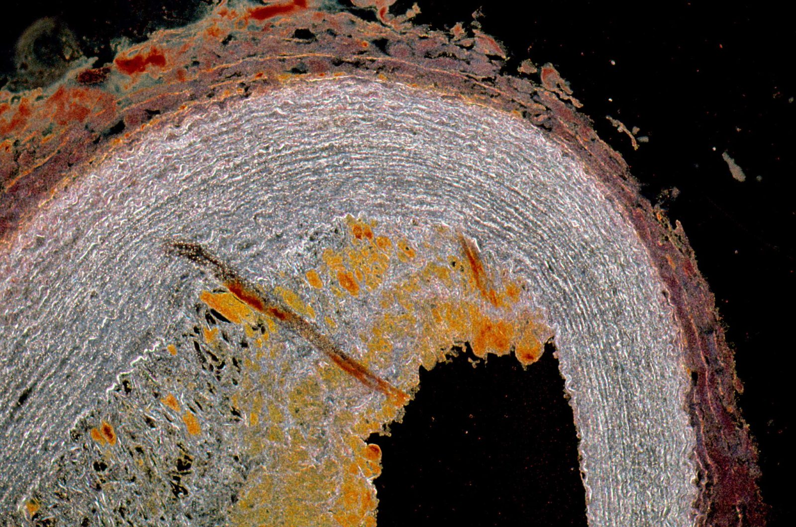 Advanced atherosclerotic lesion in a rabbit aorta | Nikon Small World