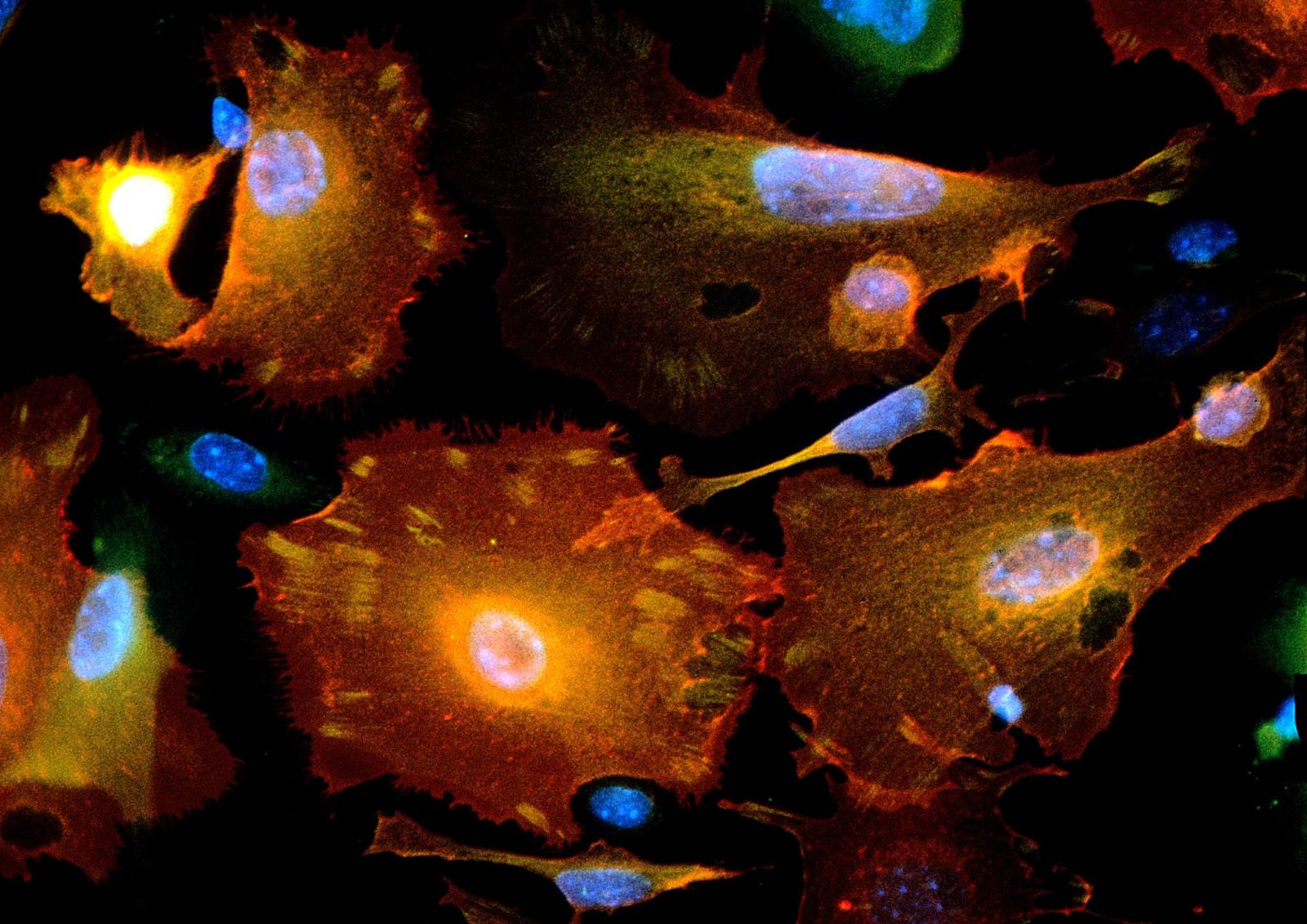 Human breast cancer cells | Nikon Small World