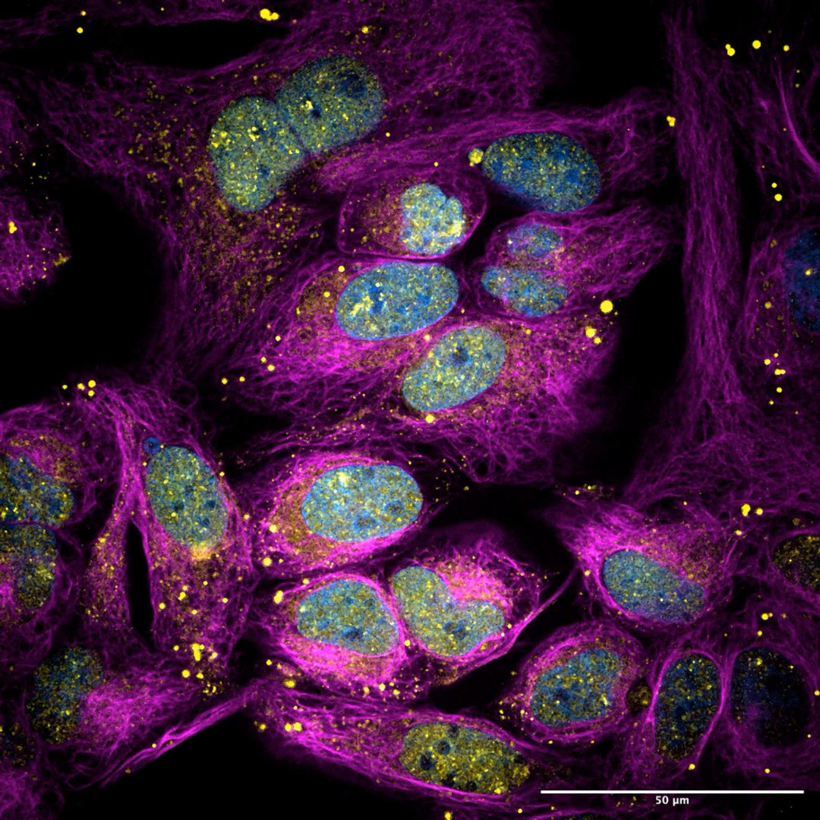 Biomolecular condensates forming in cancer cells | Nikon Small World